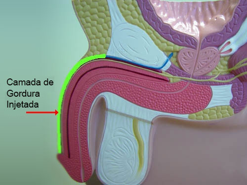 engrossamento de pênis